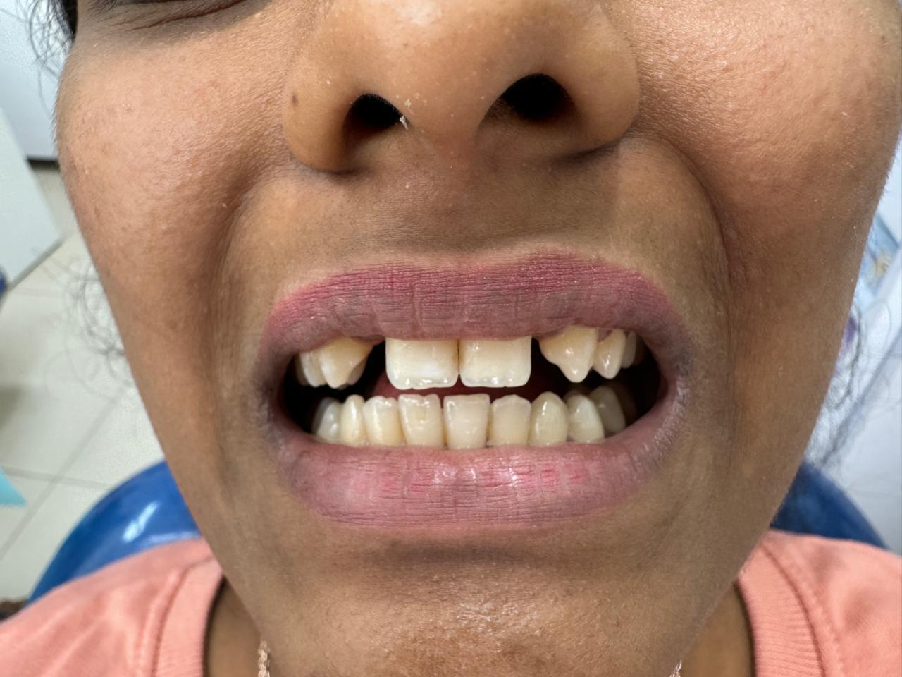 Replacement of congenitally missing front teeth before treatment
